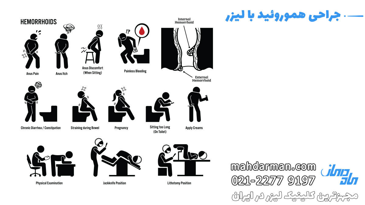 جراحی هموروئید - دکتر بواسیر و استفاده از بوتاکس مقعد برای درمان